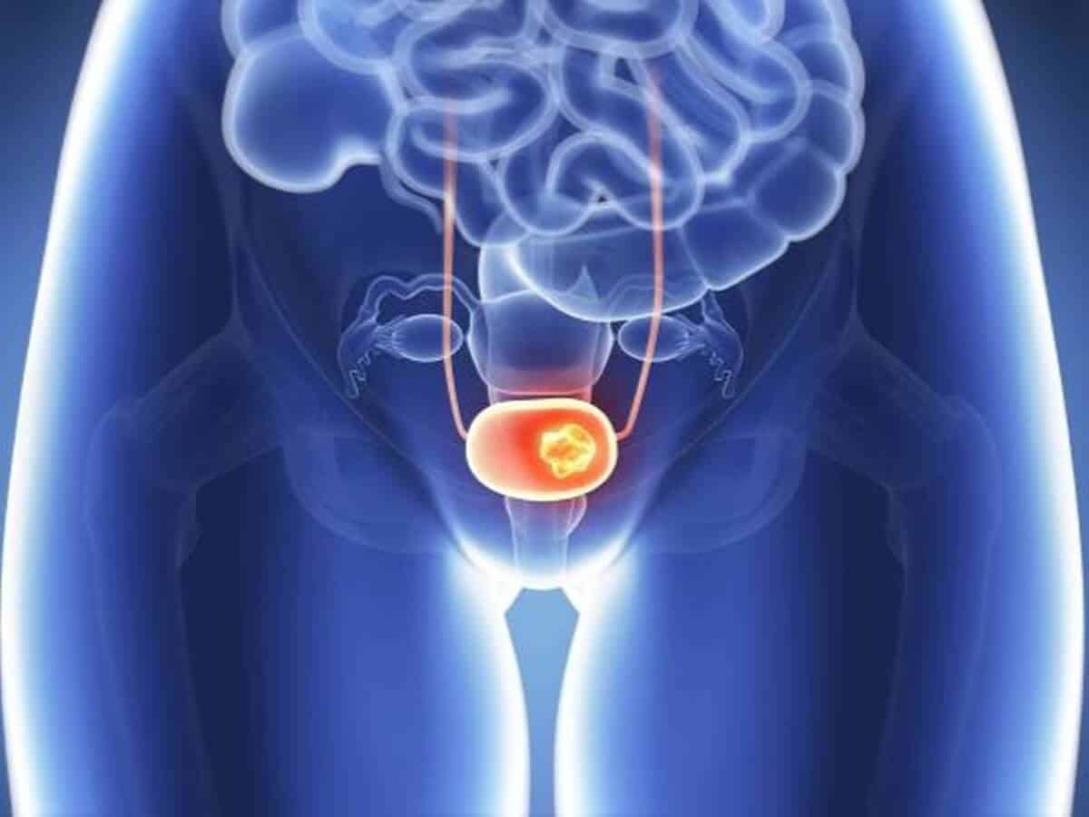 Bladder cancer on a rise in India