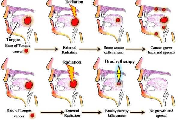 Effective Treatment of Tongue Cancer with Brachytherapy: A Complicated Procedure Mastered at Mio