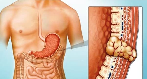 Gastrointestinal Stromal Tumors (GIST) Awareness Day