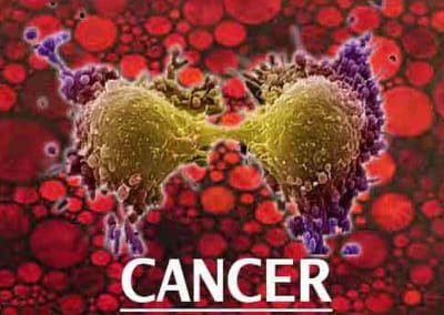 Cancer to be A Major Disease in India: Change in Lifestyle Main Culprit