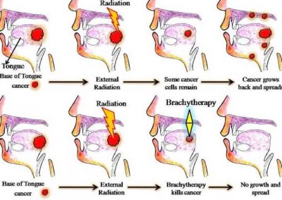 Effective Treatment of Tongue Cancer with Brachytherapy: A Complicated Procedure Mastered at Mio